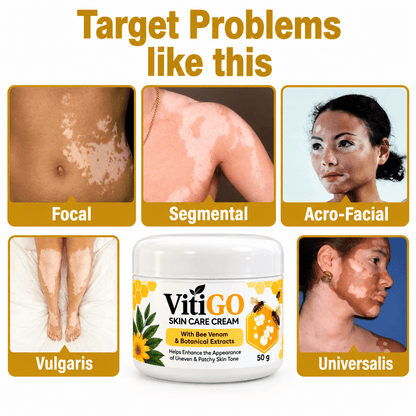 MD Advanced Vitiligo Restore Cream ✨ | Buy 1 Get 1 Free