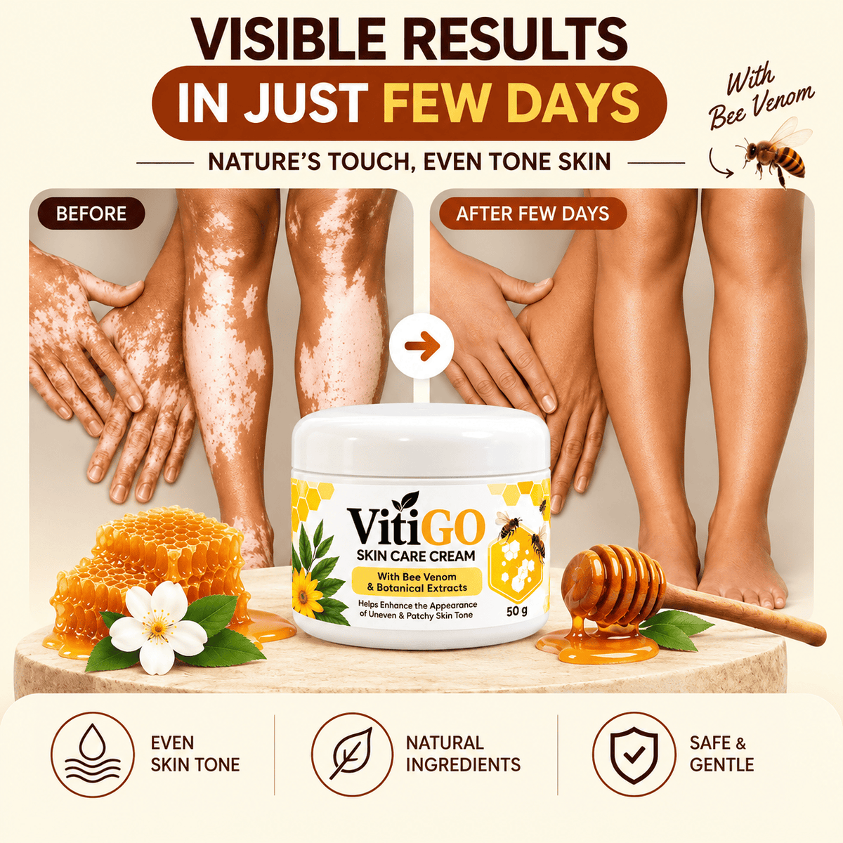 MD Advanced Vitiligo Restore Cream ✨ | Buy 1 Get 1 Free