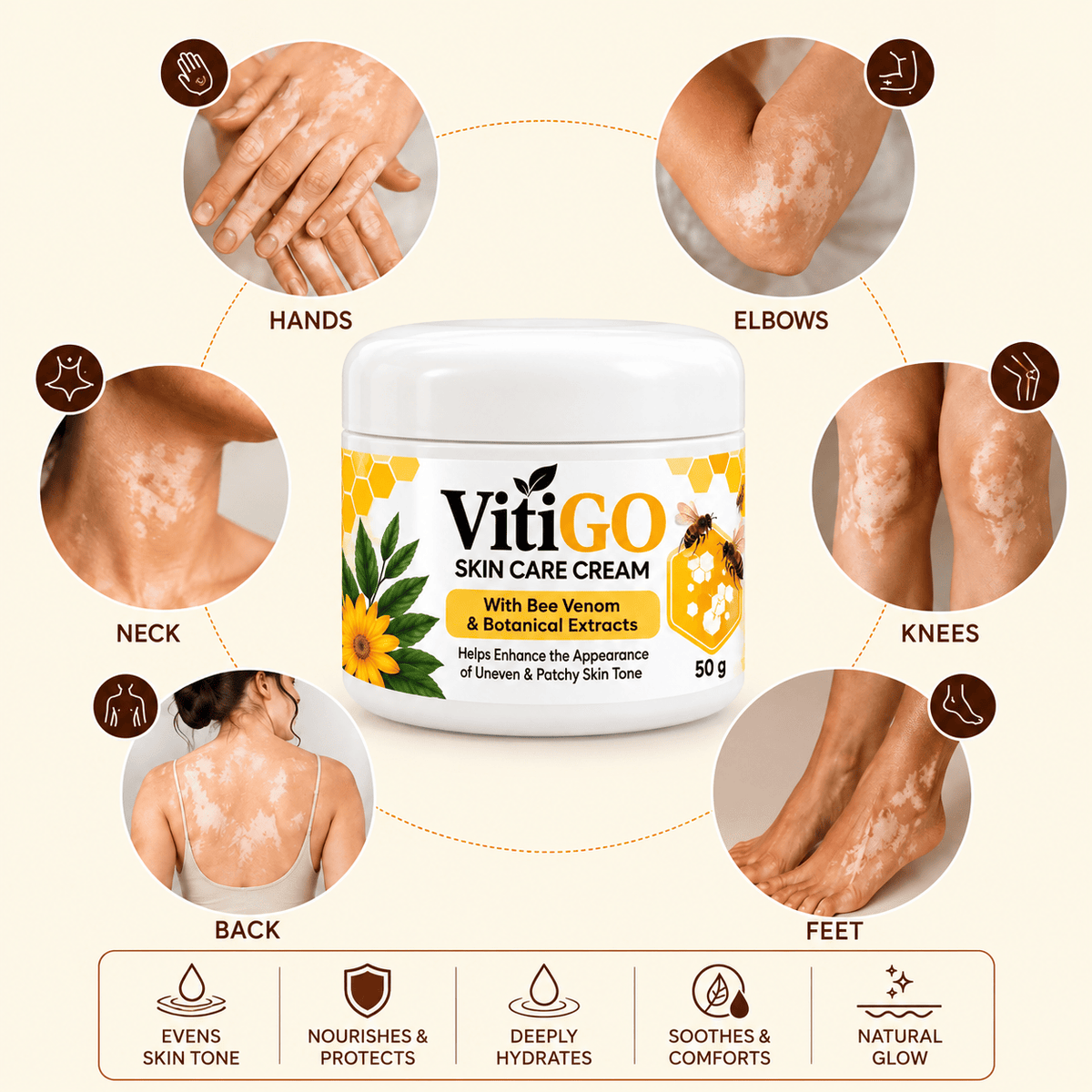 MD Advanced Vitiligo Restore Cream ✨ | Buy 1 Get 1 Free