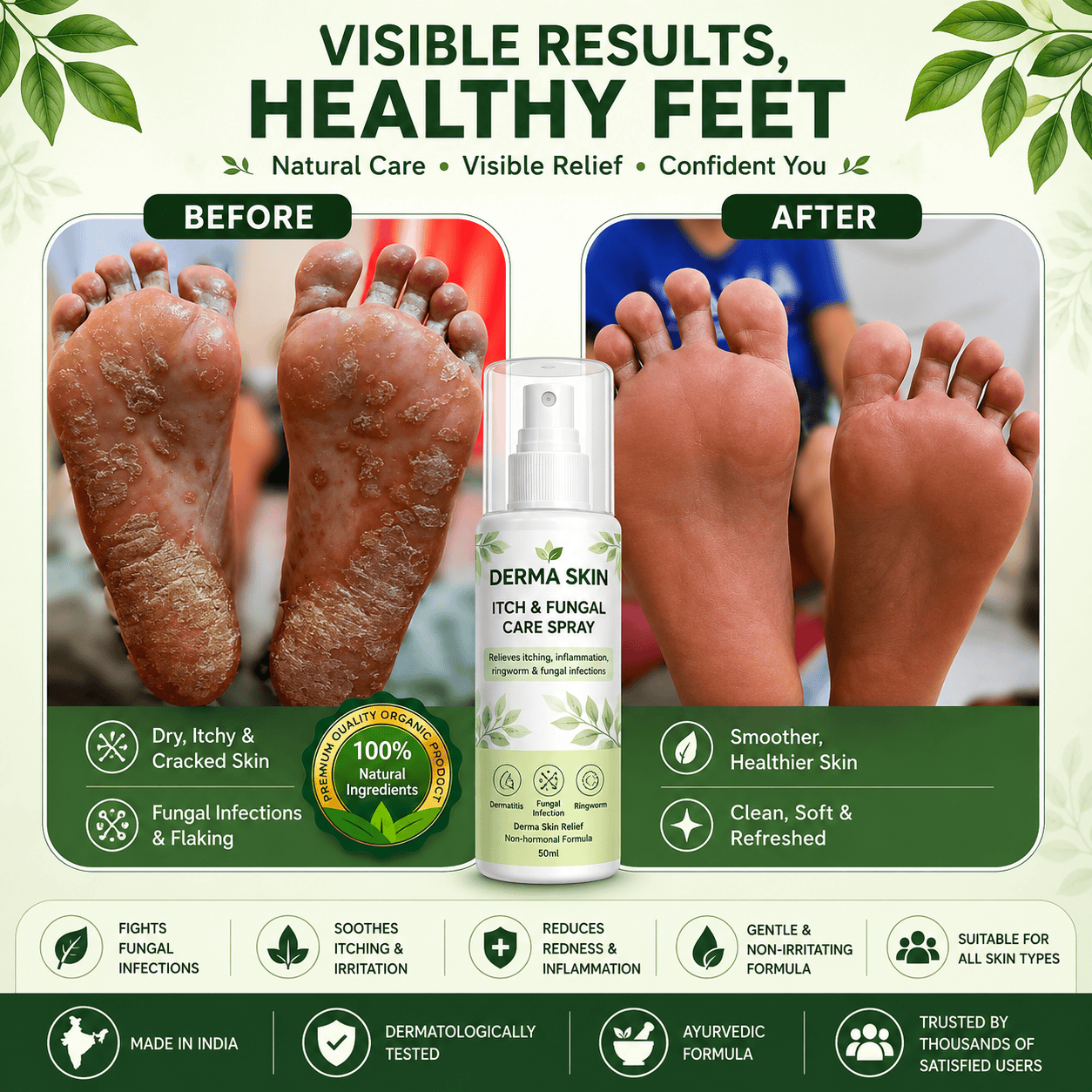 SD Derma Skin Itch & Fungal Care Spray- Dermatologist tested Itch & Fungal Care👨🏽‍⚕️