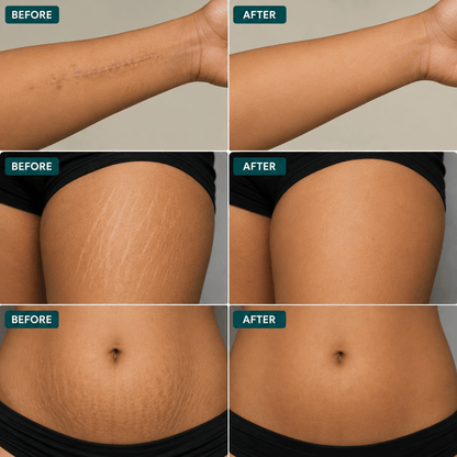 SD Scar & Stretch Mark Roll-On Serum