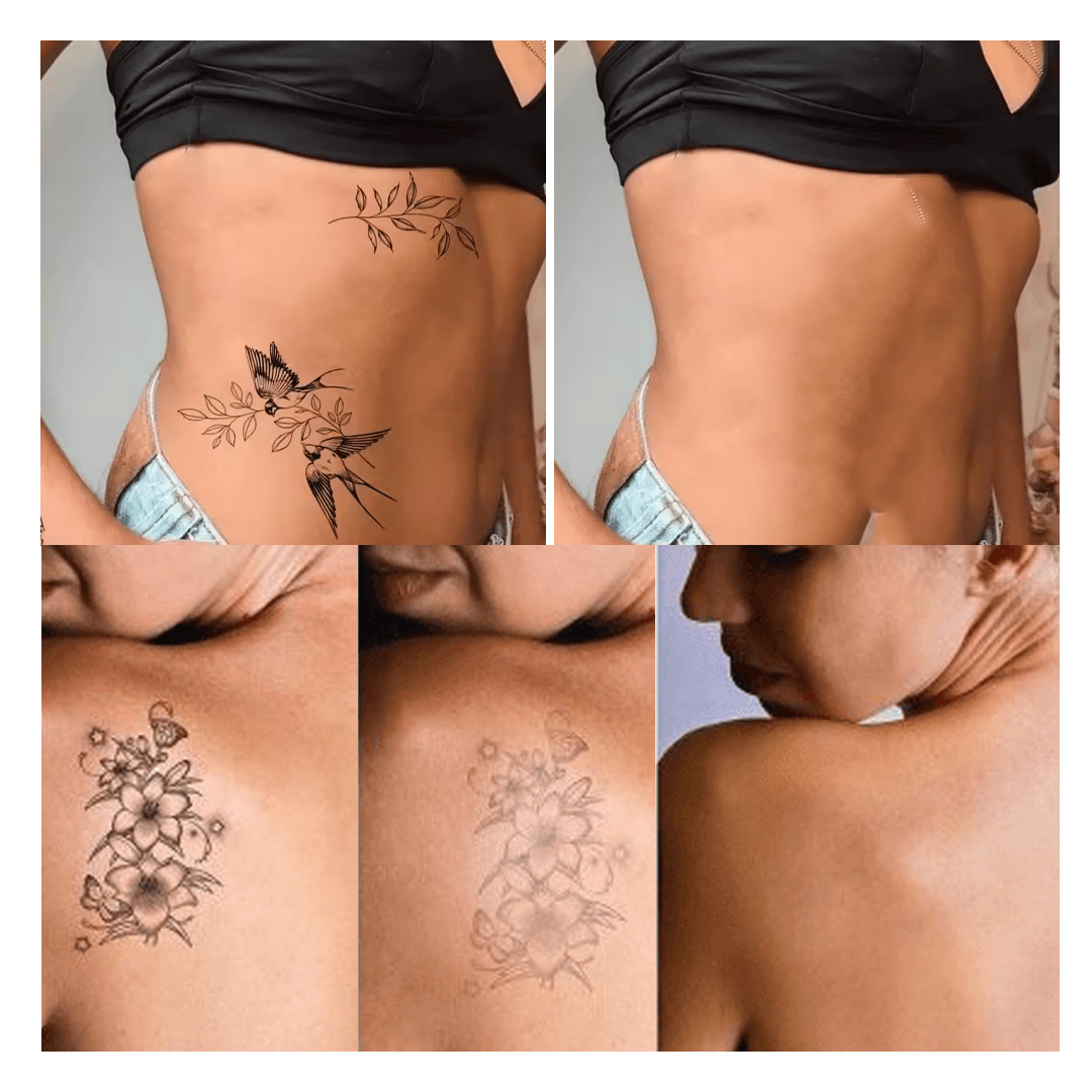 MD Quick Tattoo Removal Serum 🔥🔥 Fade Ink from Skin, Lips & Brows Fast