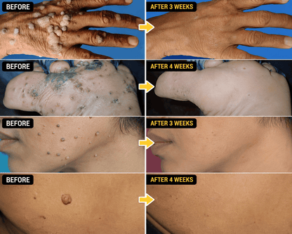 SD Bee Venom Tag & Wart Remover spray - Fast & Easy At-Home in 3 weeks