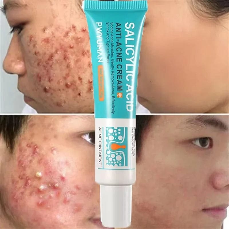SC D-More Acne-Free Glow: Salicylic Acid Anti-Acne Cream 💧 - dmore