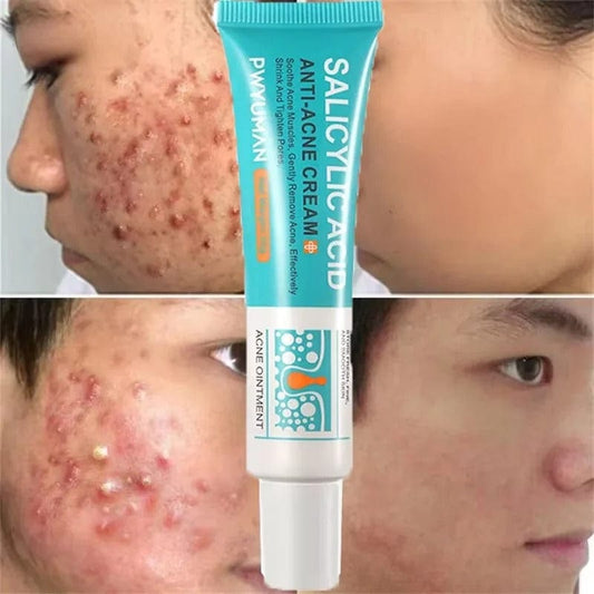 SC D-More Acne-Free Glow: Salicylic Acid Anti-Acne Cream 💧 - dmore