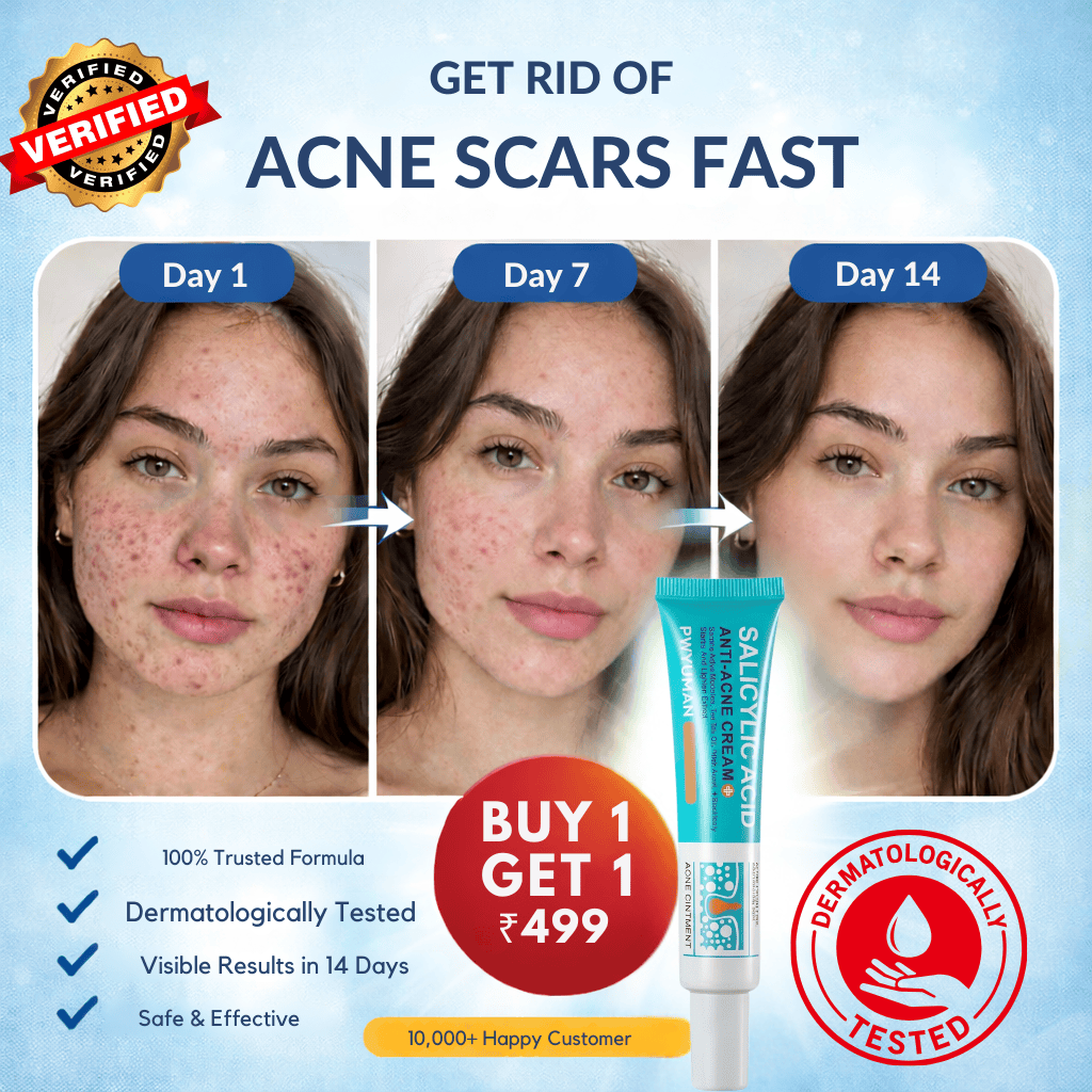 Salicylic Acid Anti-Acne Cream – Remove Stubborn Acne & Scars Fast - dmore