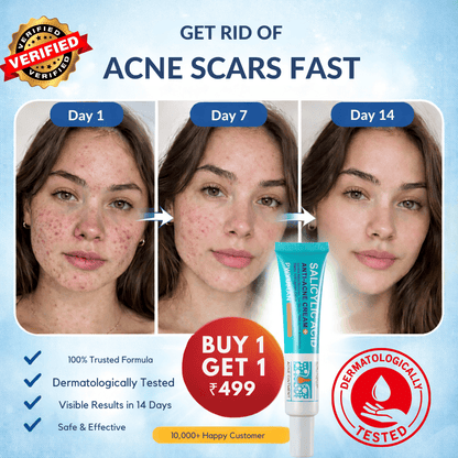 Salicylic Acid Anti-Acne Cream – Remove Stubborn Acne & Scars Fast - dmore
