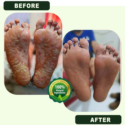 SC D-More Ecze+ Anti Fungal Spray - Doctor's Recommended 👨🏽‍⚕️ Buy 1 Get 1 Free - dmore