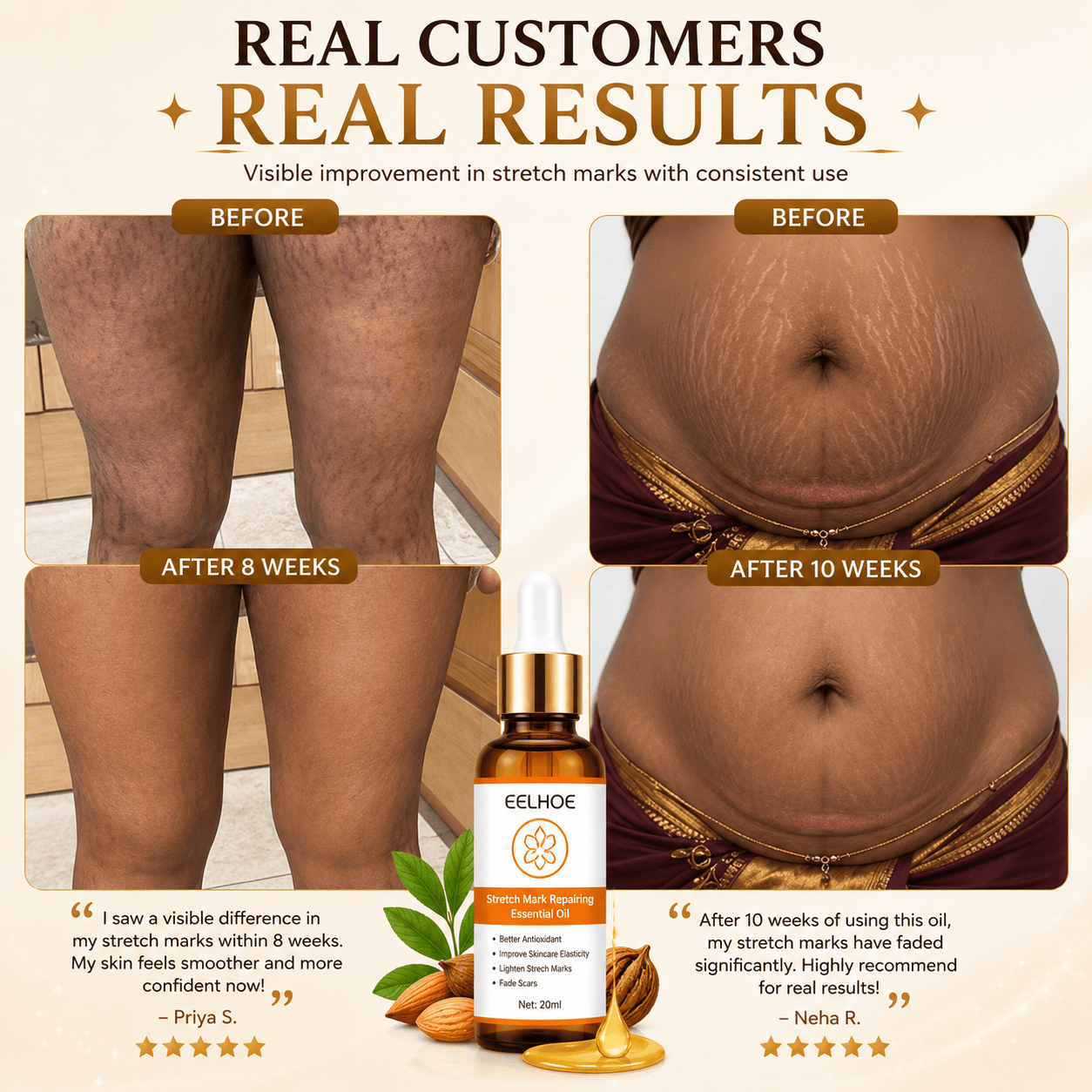 Doctor Approved Stretch Mark Oil Visible Results in just 14 Days