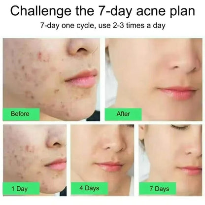 SC D-More Acne-Free Glow: Salicylic Acid Anti-Acne Cream 💧 - dmore