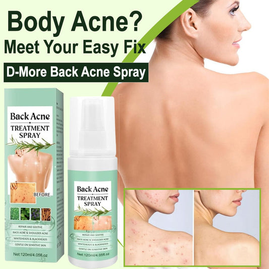 MD Back Acne Spray – Easy, Effective, Acne-Free 🌿