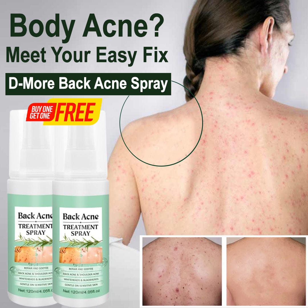 SD Back Acne Spray – Easy, Effective, Acne-Free 🌿