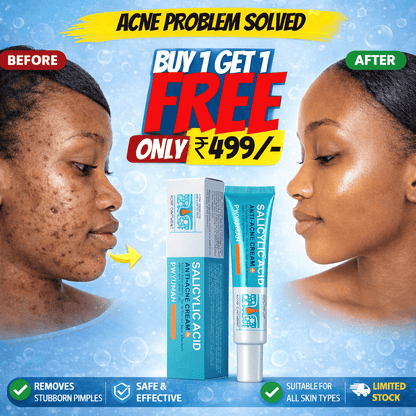 SD Salicylic Acid Anti-Acne Cream 💧 :  Acne-Free Glow - dmore