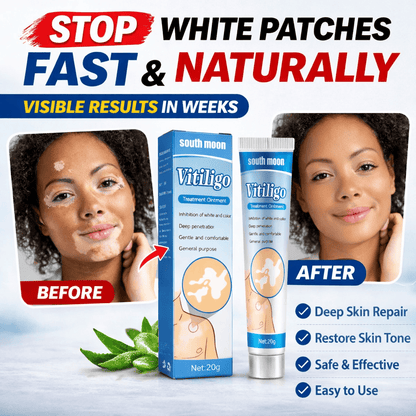 South Moon Vitiligo Treatment Ointment – Advanced Skin Repair Formula - dmore