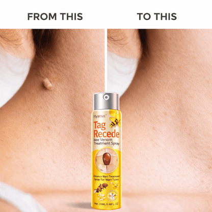 SD Bee Venom Tag & Wart Remover spray - Fast & Easy At-Home in 3 weeks - dmore