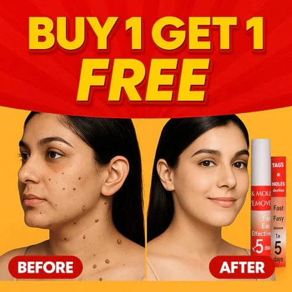 SD Warts & Tags Remover 🌿 Limited Time (Buy 1 Get 1 FREE)🔥Fast, Safe, Effective - dmore