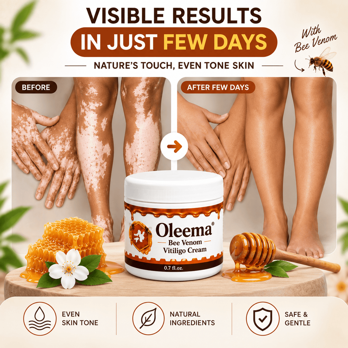 MD Oleema Advanced Vitiligo Restore Cream ✨ | Buy 1 Get 1 Free