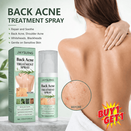 SD Back Acne Spray – Easy, Effective, Acne-Free 🌿 - dmore