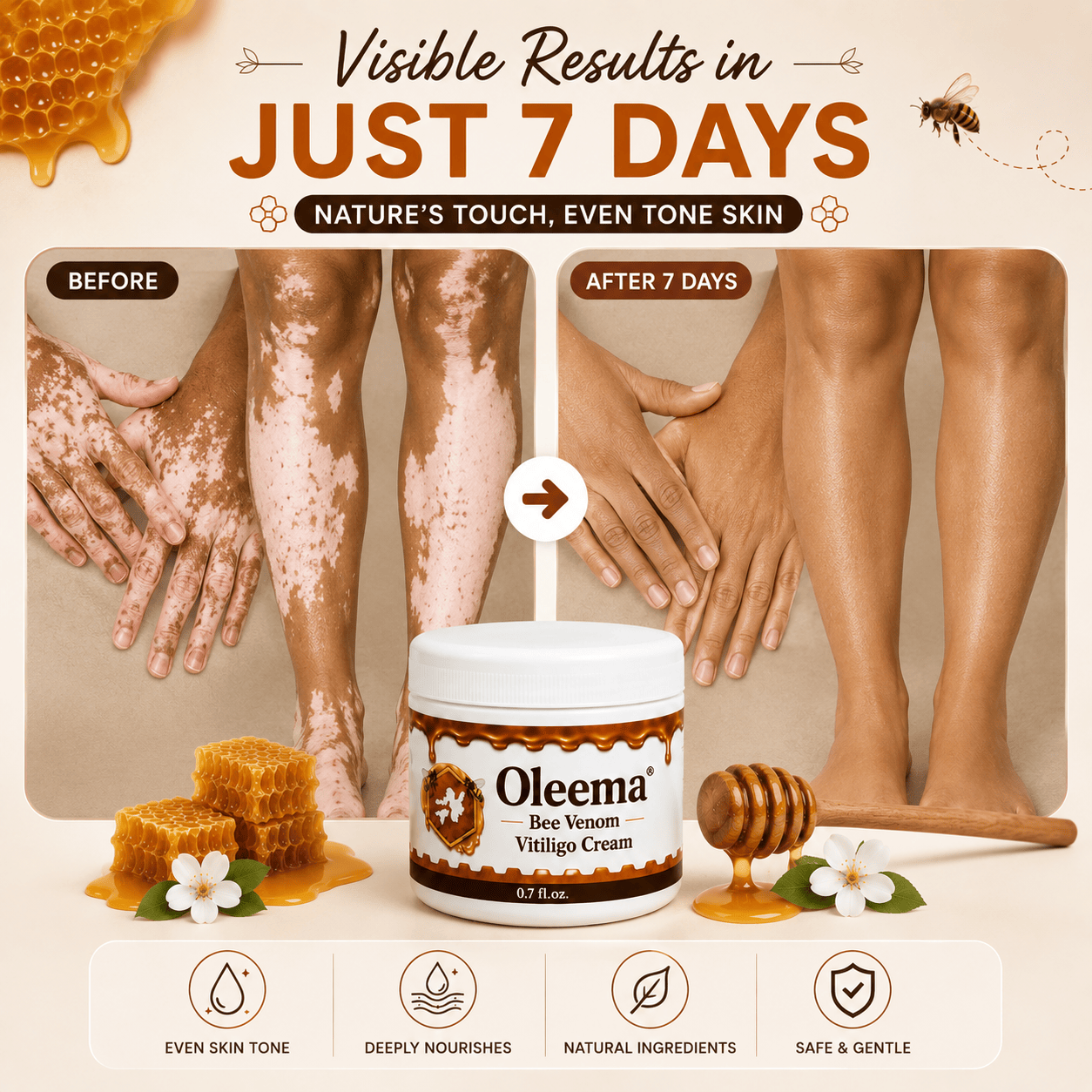 SD Oleema Advanced Vitiligo Restore Cream ✨ | Buy 1 Get 1 Free