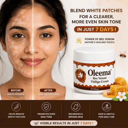 SD Oleema Advanced Vitiligo Restore Cream ✨ | Buy 1 Get 1 Free