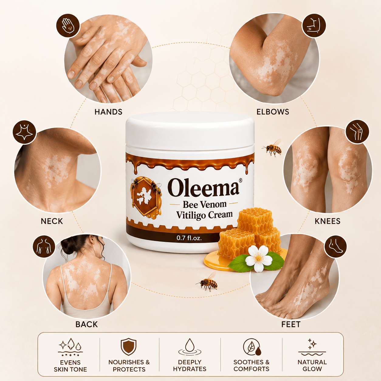 SD Oleema Advanced Vitiligo Restore Cream ✨ | Buy 1 Get 1 Free