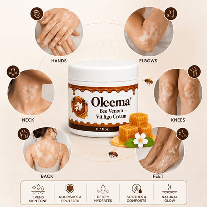 SD Oleema Advanced Vitiligo Restore Cream ✨ | Buy 1 Get 1 Free