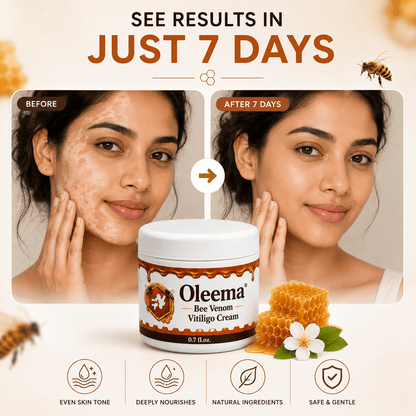 SD Oleema Advanced Vitiligo Restore Cream ✨ | Buy 1 Get 1 Free