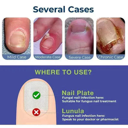 💅SD Anti-Paronychia Nail Relief Oil  🔥 Buy 1 Get 1 FREE @ Just ₹399! 🔥