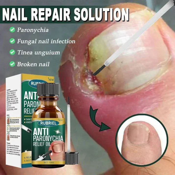 💅SD Anti-Paronychia Nail Relief Oil  🔥 Buy 1 Get 1 FREE @ Just ₹399! 🔥