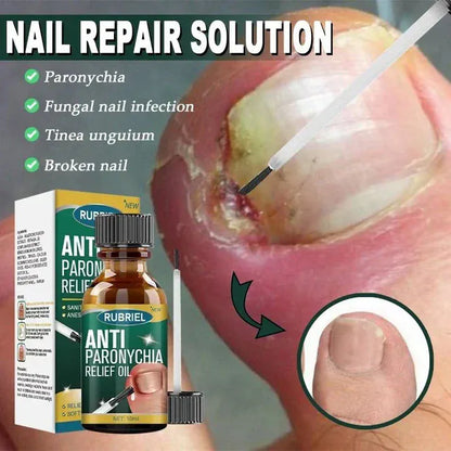 💅SD Anti-Paronychia Nail Relief Oil  🔥 Buy 1 Get 1 FREE @ Just ₹399! 🔥