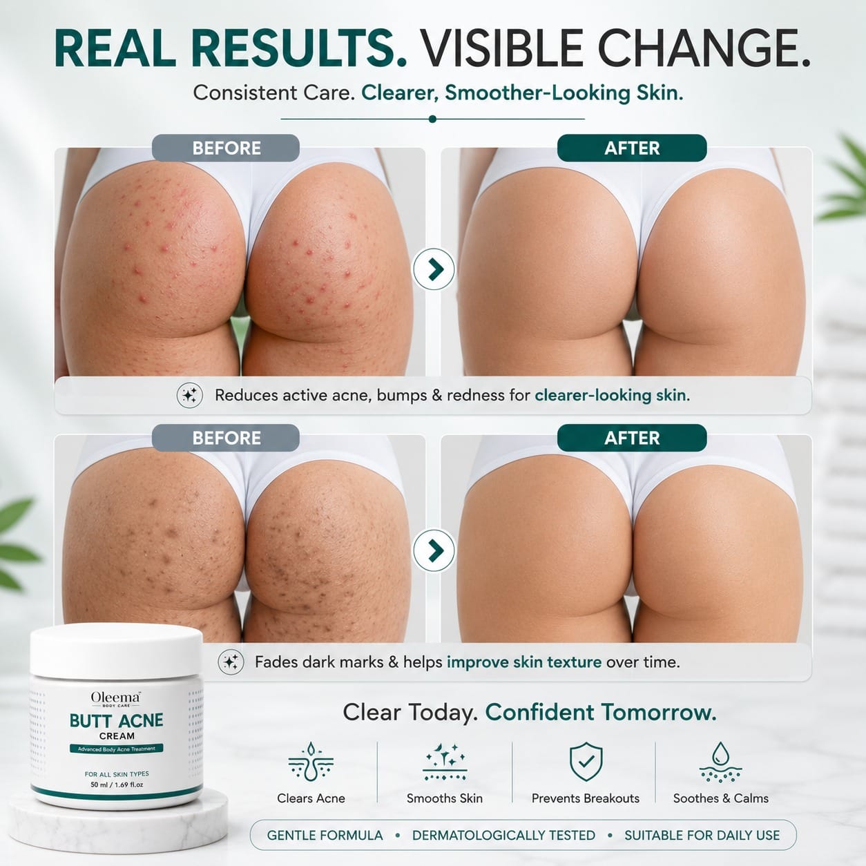 SD Butt Acne Cream For Bumps, Breakouts & Uneven Skin on Your Bum & Body