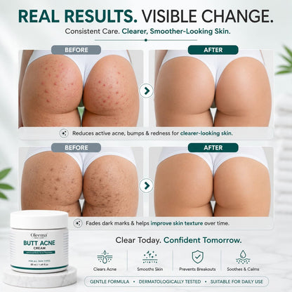 SD Butt Acne Cream For Bumps, Breakouts & Uneven Skin on Your Bum & Body