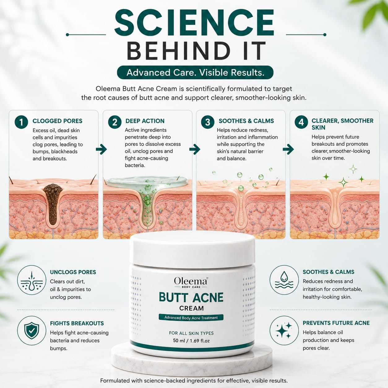 SD Butt Acne Cream For Bumps, Breakouts & Uneven Skin on Your Bum & Body