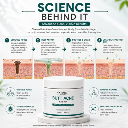 SD Butt Acne Cream For Bumps, Breakouts & Uneven Skin on Your Bum & Body