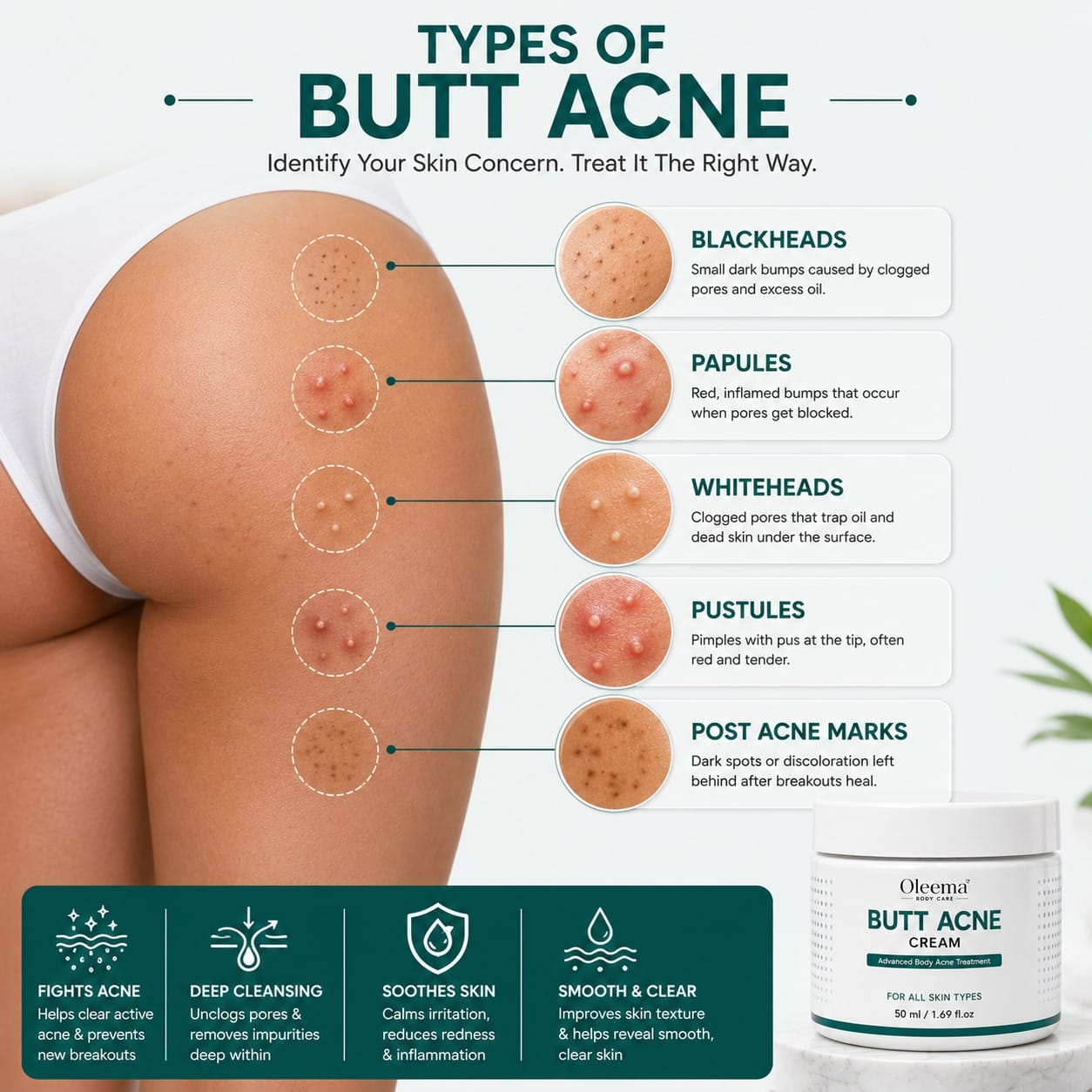 SD Butt Acne Cream For Bumps, Breakouts & Uneven Skin on Your Bum & Body