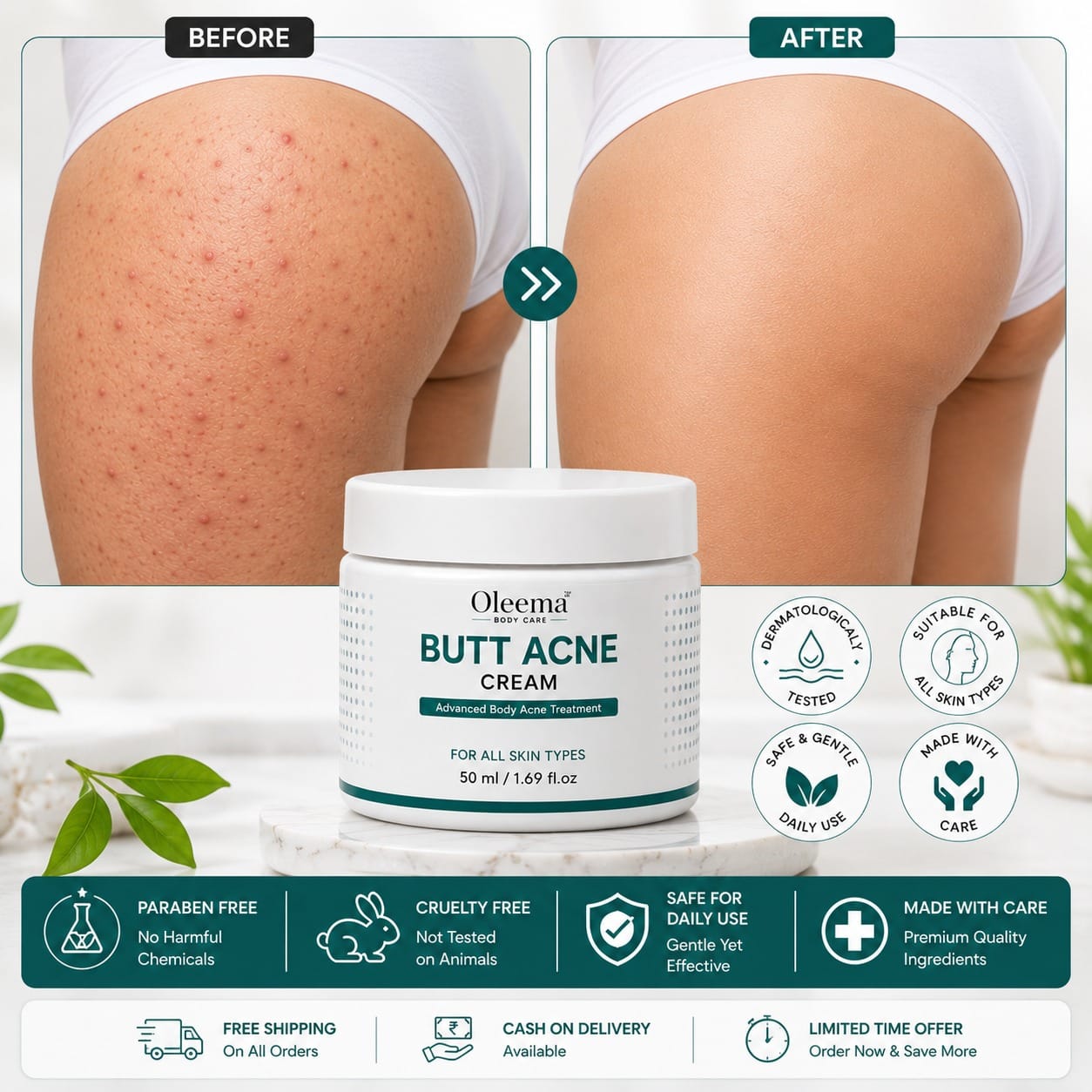 SD Butt Acne Cream For Bumps, Breakouts & Uneven Skin on Your Bum & Body