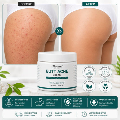 SD Butt Acne Cream For Bumps, Breakouts & Uneven Skin on Your Bum & Body