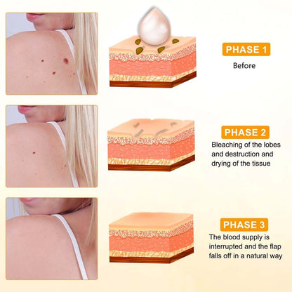 MD ✨ Instantly Remove Warts, Skin Tags & Moles – Painlessly & Safely! - dmore