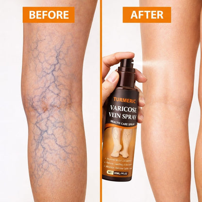 MD Herbal Turmeric Varicose Vein Spray – Feel Relief in Minutes 🌿🟡 - dmore