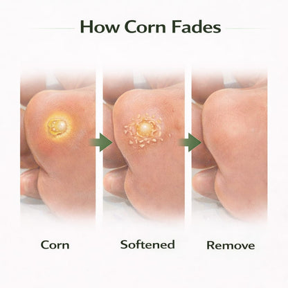 SD Corn Removal Serum 👣 No More Pain, No More Corns - ✨ Buy 1 Get 1 Free ⚡ - dmore