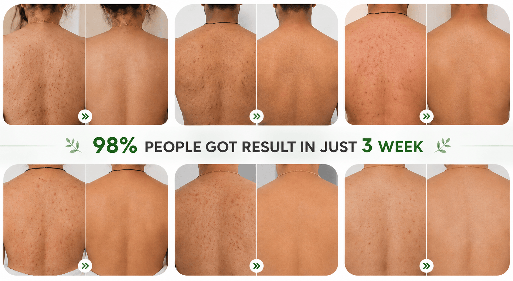 MD Back Acne Spray – Easy, Effective, Acne-Free 🌿 - dmore