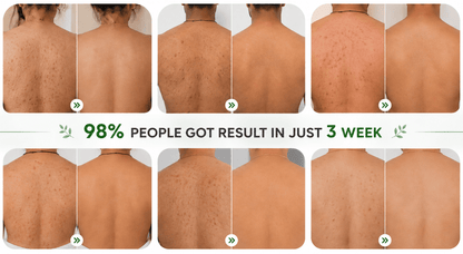 MD Back Acne Spray – Easy, Effective, Acne-Free 🌿 - dmore