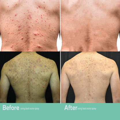 SC D-More Back Acne Spray – Easy, Effective, Acne-Free 🌿 - dmore