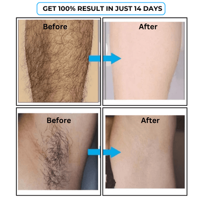 SD Hair Inhibitor Serum – Effortless Hair Reduction 💧 - dmore