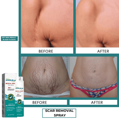 SD Scar Removal Spray - Say Goodbye to Scars🌿 🌼 - dmore