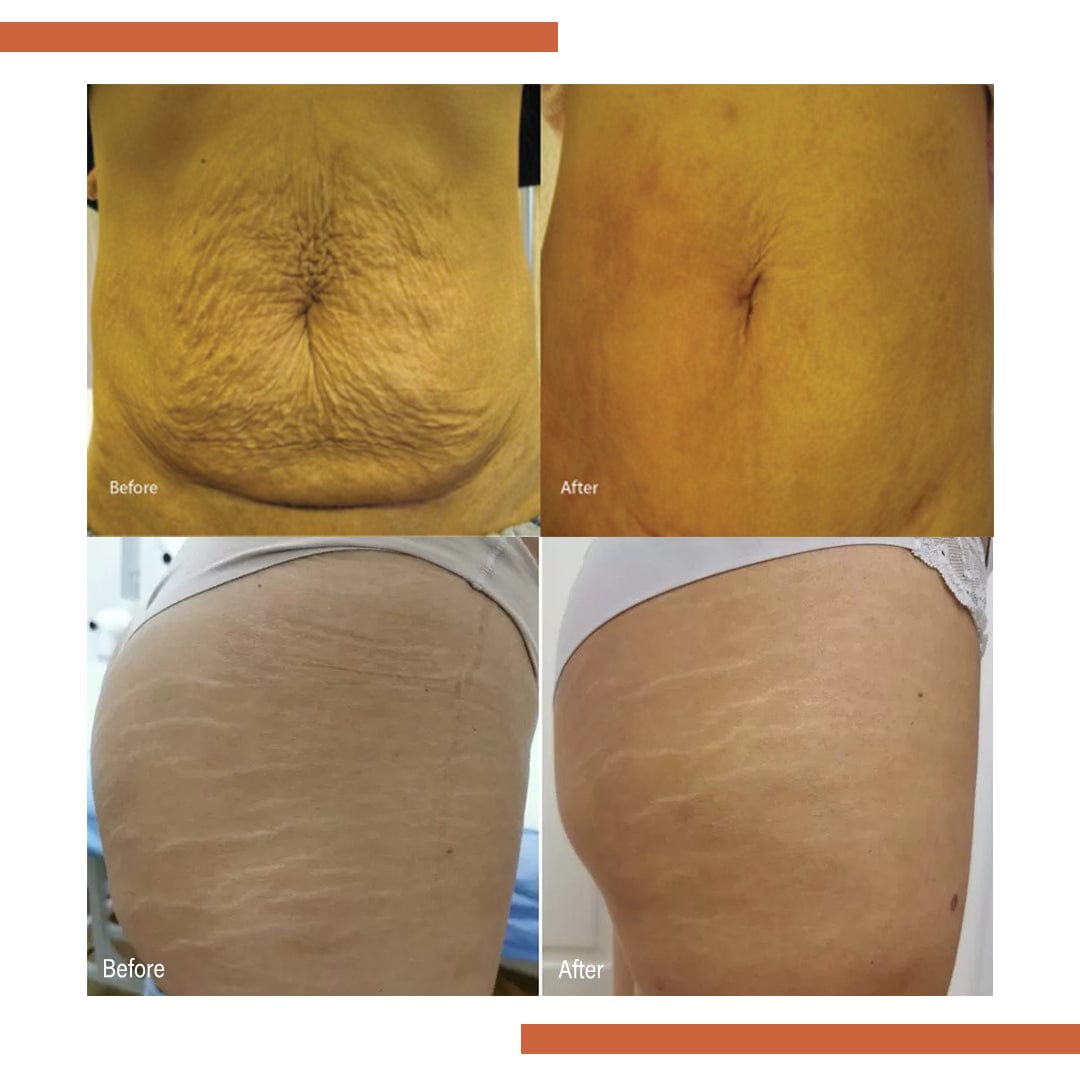 🌿 SC D-More Doctor's Approved Stretch Mark Oil – Naturally Effective! 🌿 - dmore