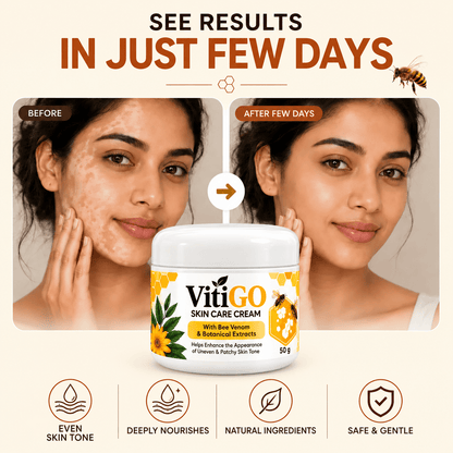 MD Advanced Vitiligo Restore Cream ✨ | Buy 1 Get 1 Free