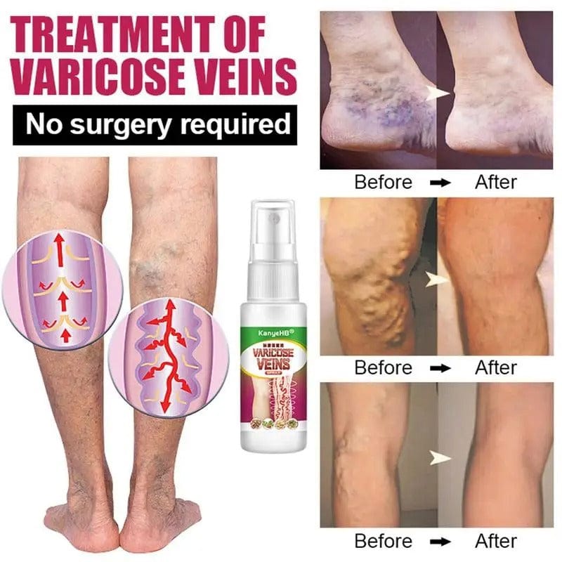 MD Herbal Varicose Vein Spray - Instant Relief & Vein Care Solution! 👨🏻‍⚕️ 💚 PACK 2