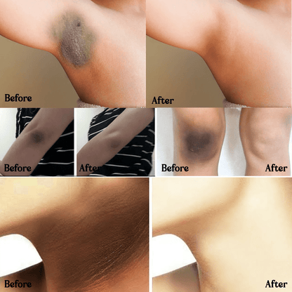 SD Acanthosis Nigricans Oil – The Herbal Solution for Dark Patches🌿 - dmore