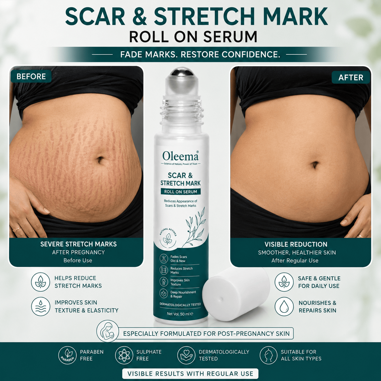 SD Scar & Stretch Mark Roll-On Serum